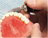 治療用義歯の調整~試用~再調整