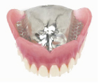 コバルトクローム義歯