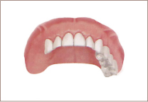 複数の歯が無い症例