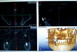 歯科用CT画像処理ソフト